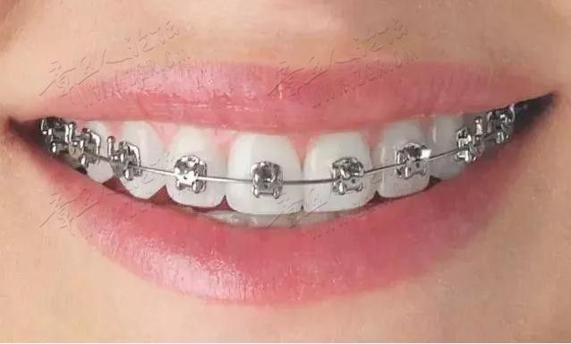 牙齿矫正前必看：常见的几种牙套优缺点总结作为一位正畸医生助理 ...-3.jpg