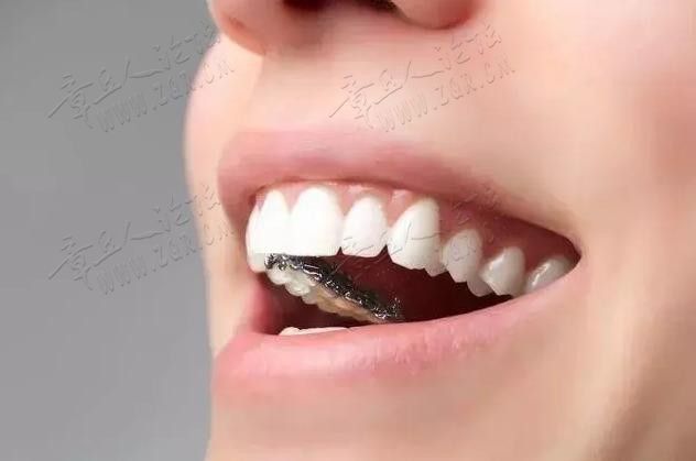 牙齿矫正前必看：常见的几种牙套优缺点总结作为一位正畸医生助理 ...-11.jpg