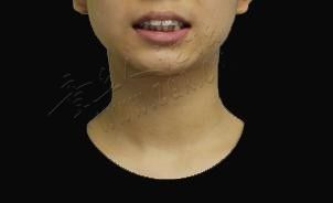 坐标广州，拔了4颗牙，球面牙套8个月，不磨嘴没掉托槽，女儿的龅 ...-2.jpg